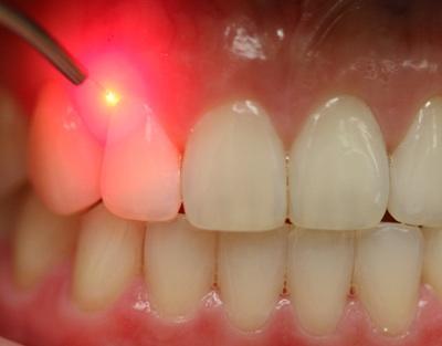 Periodontal Maintenance Frequency